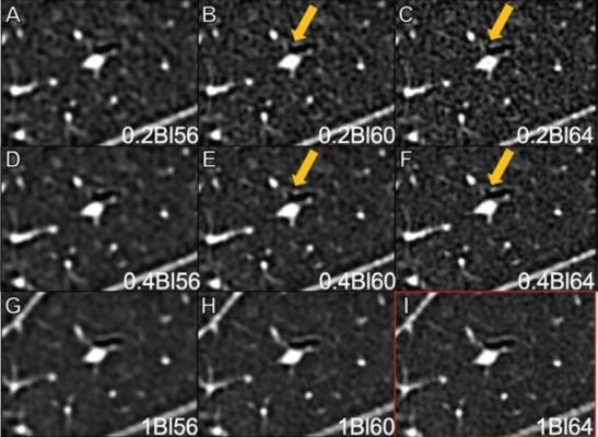 CT Imaging Advancements Bring New Level of Detail