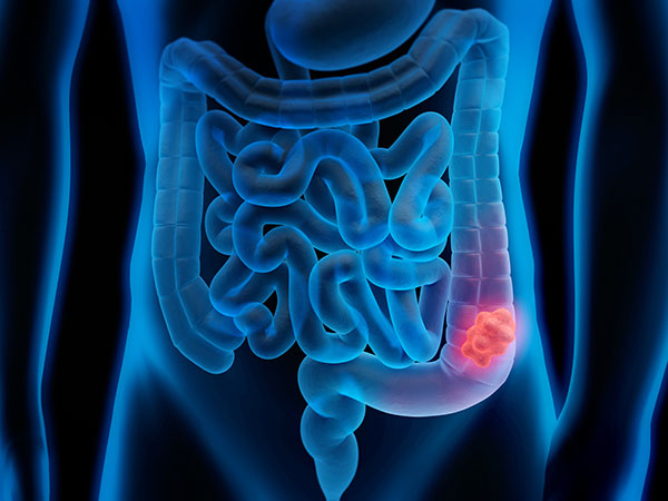 Prevention and Early Detection: The Importance of Colorectal Cancer Screenings