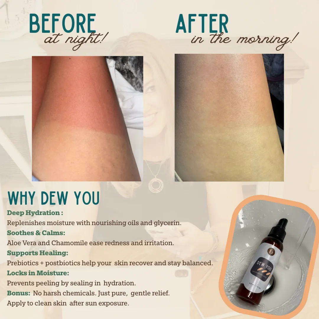 Immediate Relief for Sunburn