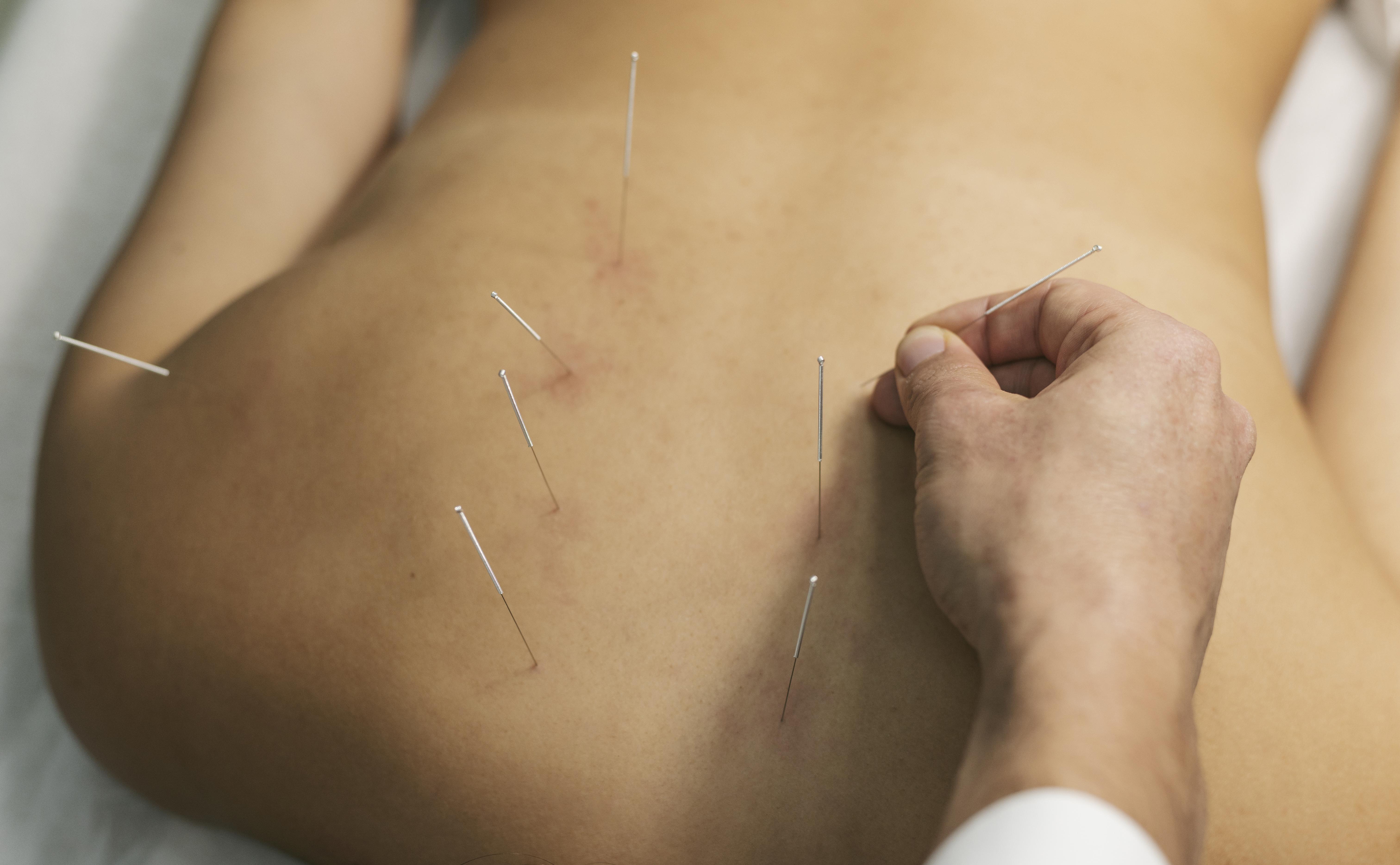 Acupuncture for cancer recovery Acupuncture for cancer recovery