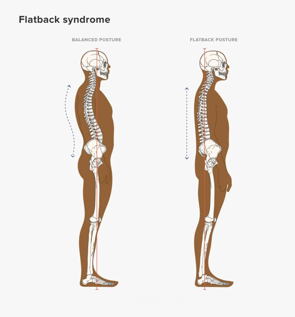 Flat Back Posture Comparison