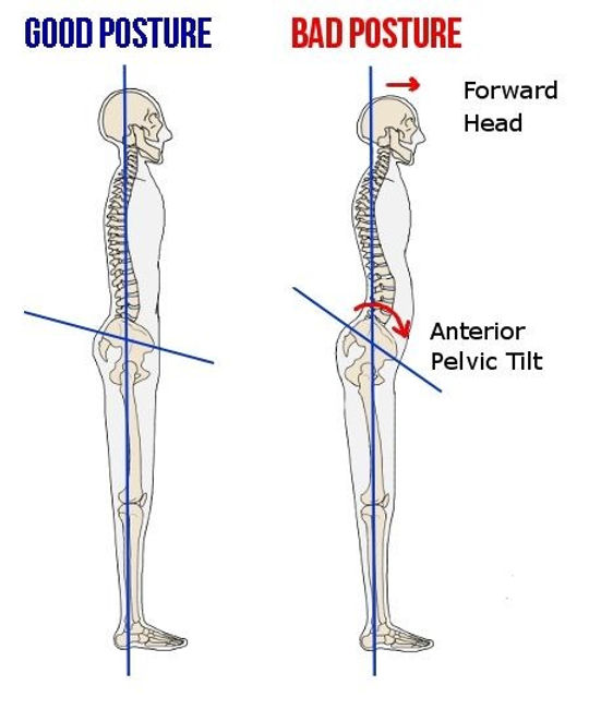 Anterior Pelvic Tilt Posture Comparison