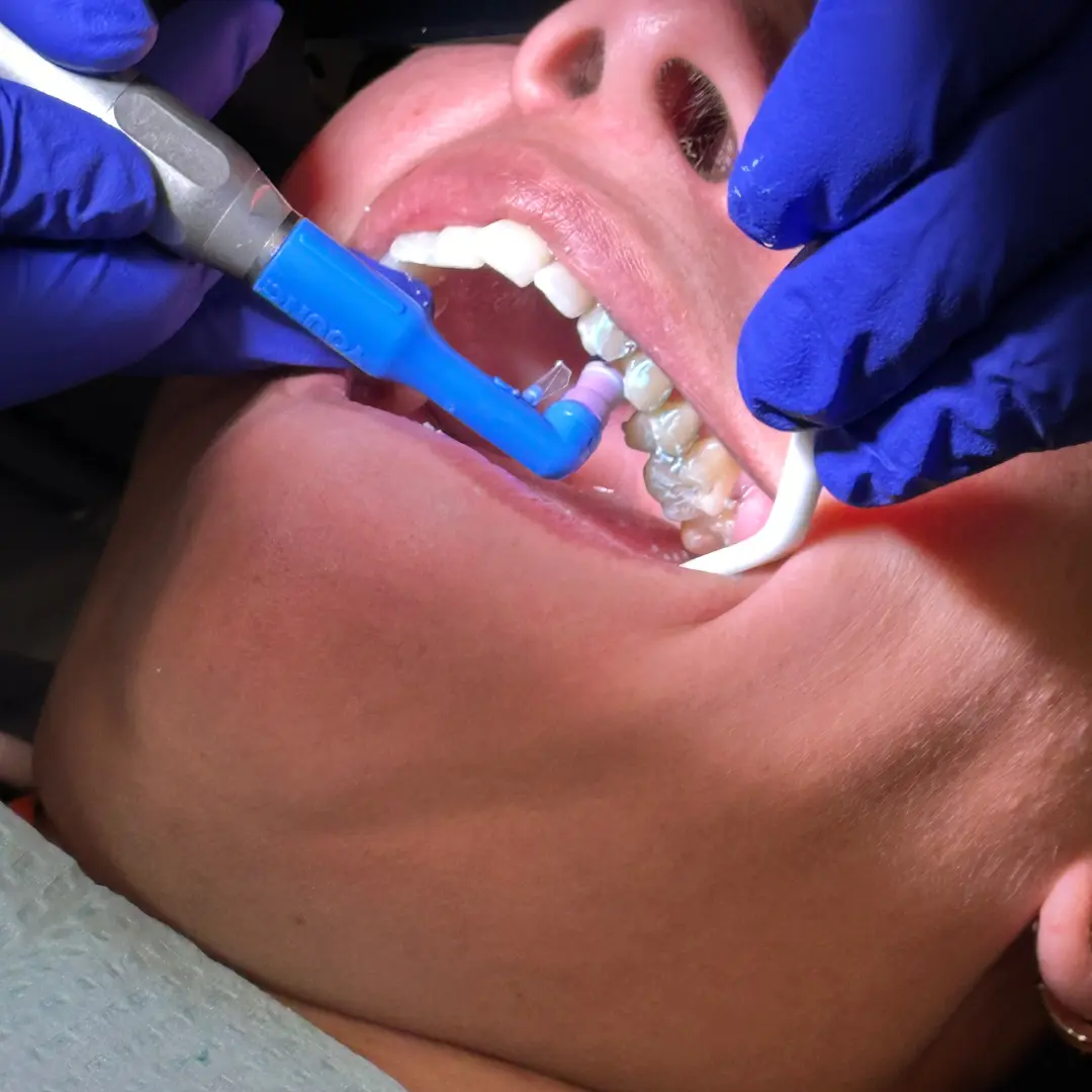 Indiana Coronal Polishing and Fluoride Course