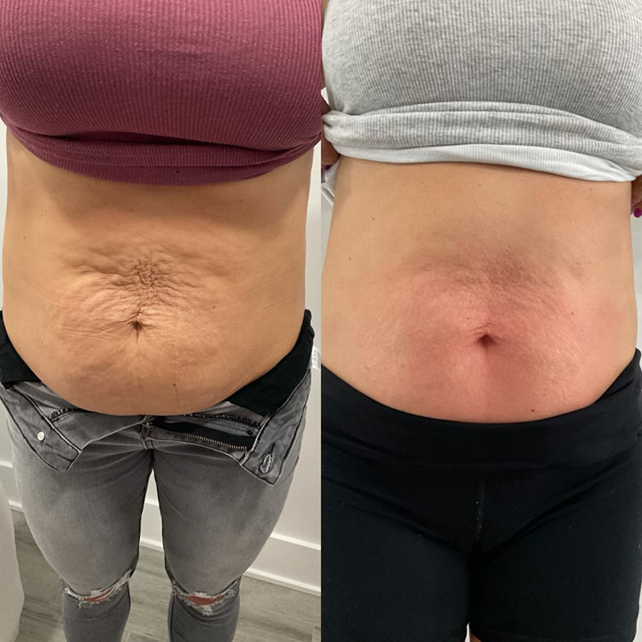 fat reduction results