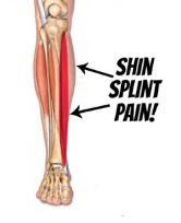 Shin splint pain