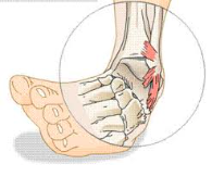 ankle injuries