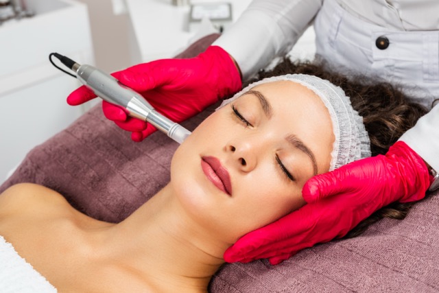 Microneedling with Exosomes