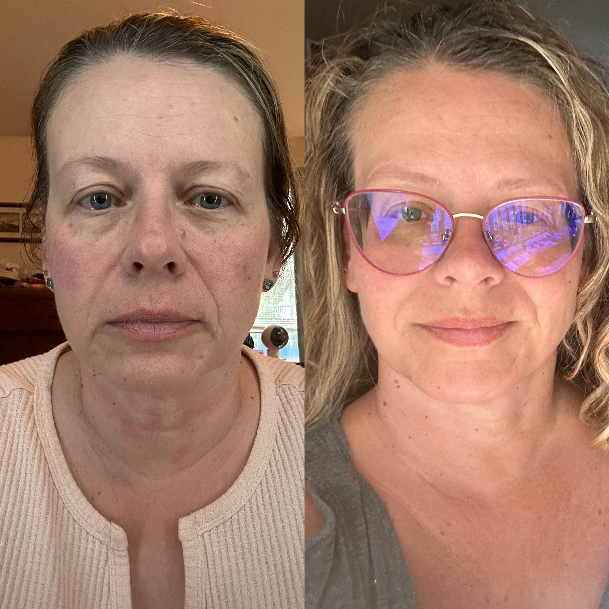 face taping before and after face taping before and after