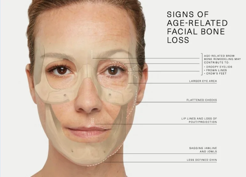 bones and facial aging