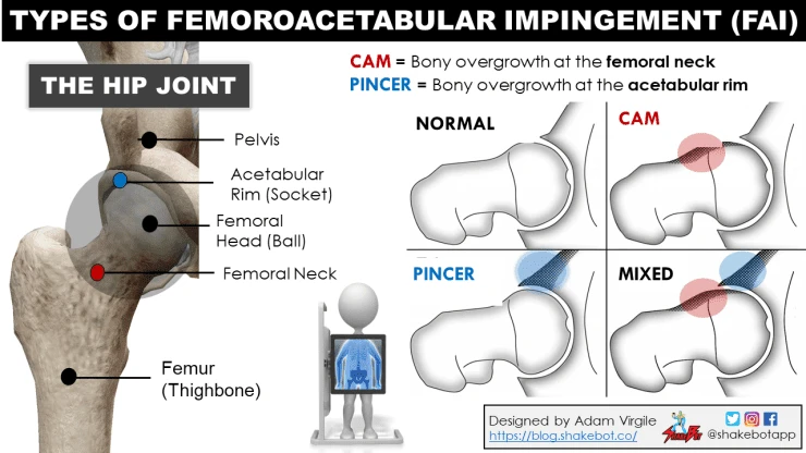 Young female AAA hockey player experiencing chronic hip and low back tightness caused by upstream compensation from foot-ankle dysfunction