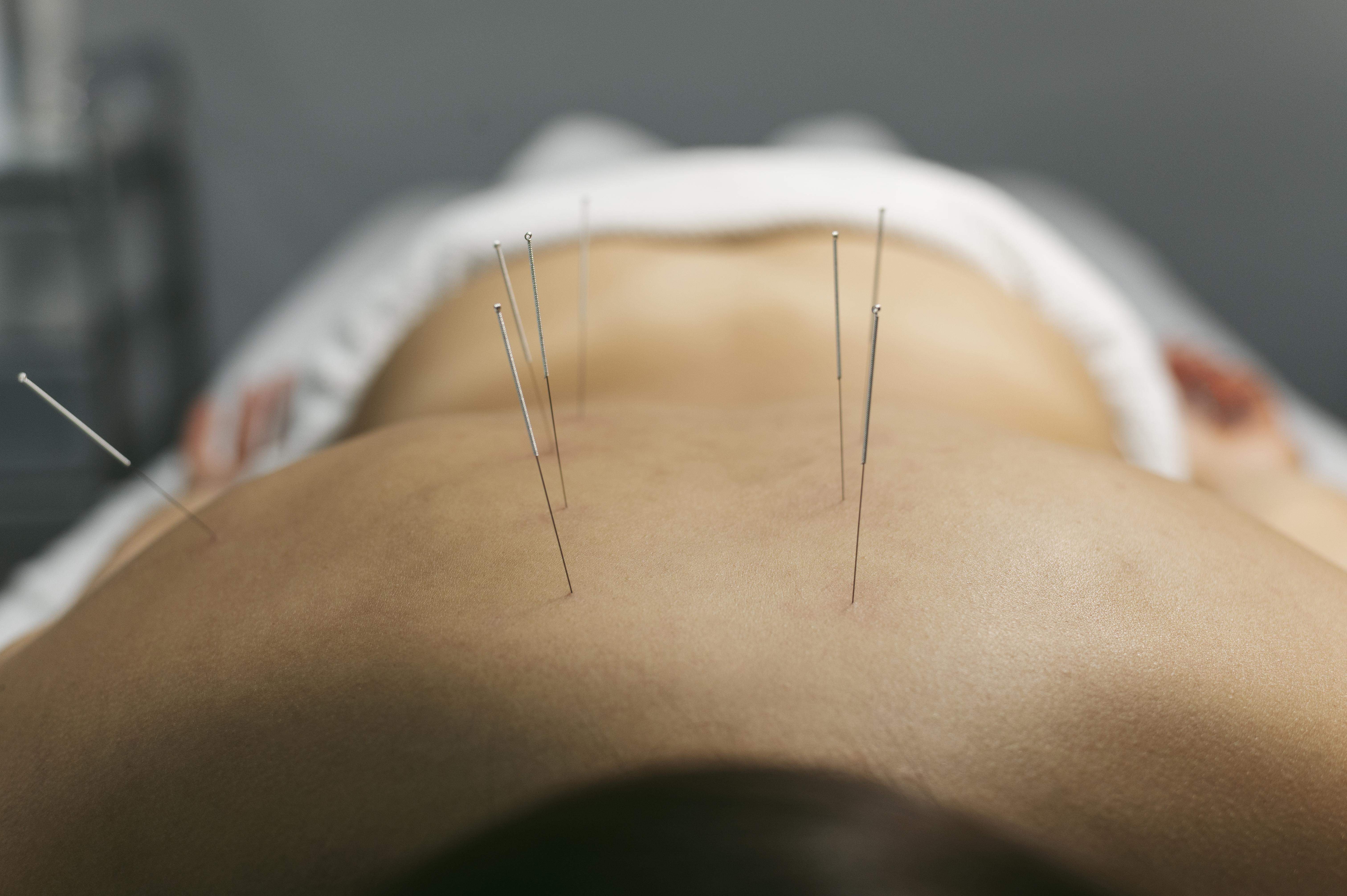 Physical therapist performing dry needling on shoulder muscle for pain relief. Physical therapist performing dry needling on shoulder muscle for pain relief.