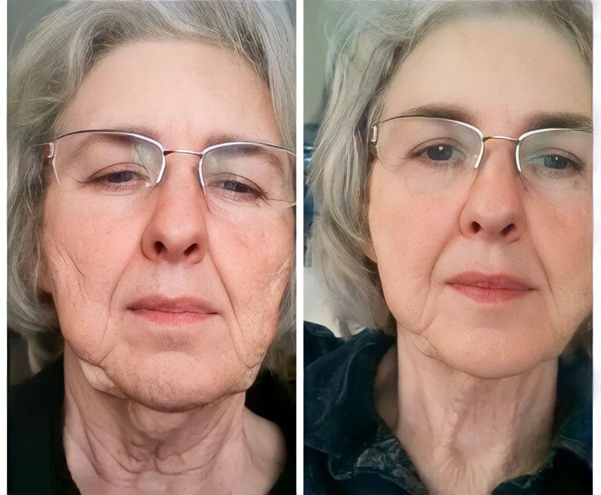 Loose Skin After Weight Loss using red light therapy bed and T-Shock