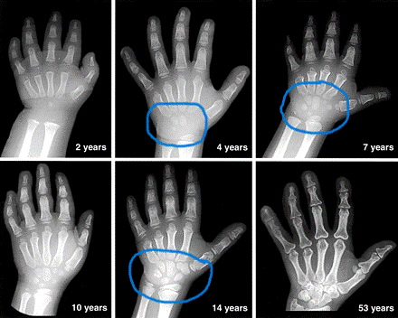 wrist bone development