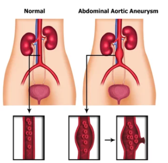 Aortic Aneurysm and Life insurance Aortic Aneurysm and Life insurance