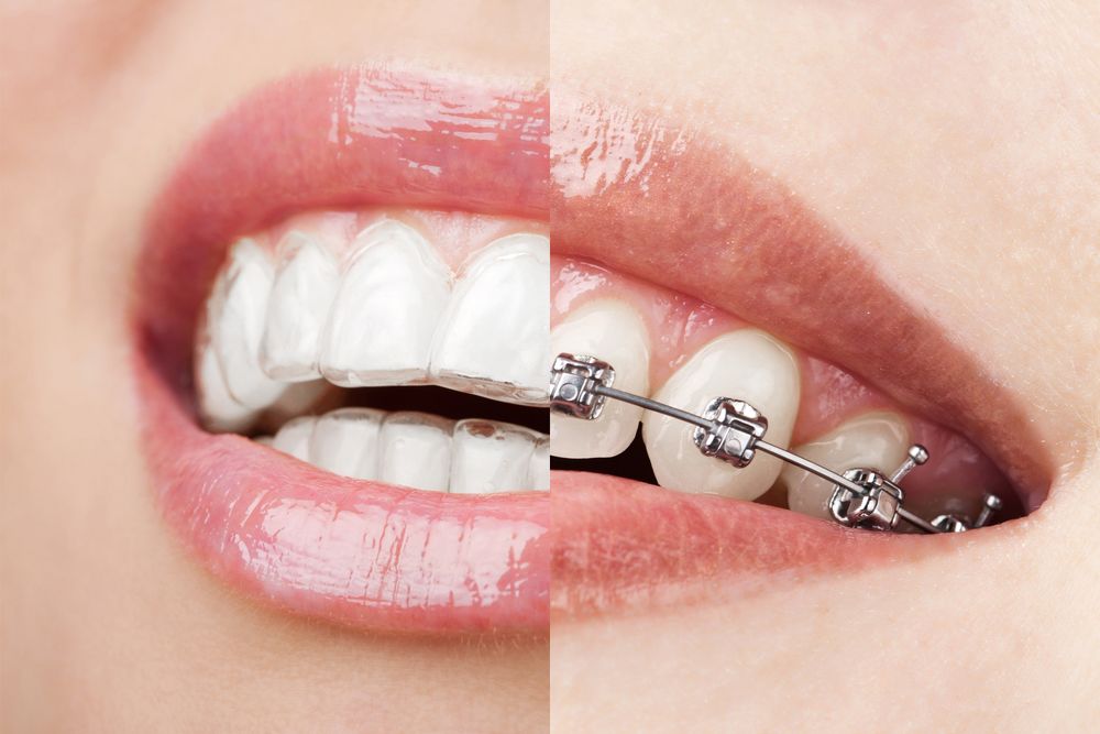 inv-braces