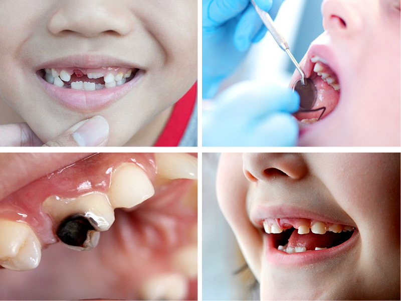 Addressing Common Pediatric Dental Issues