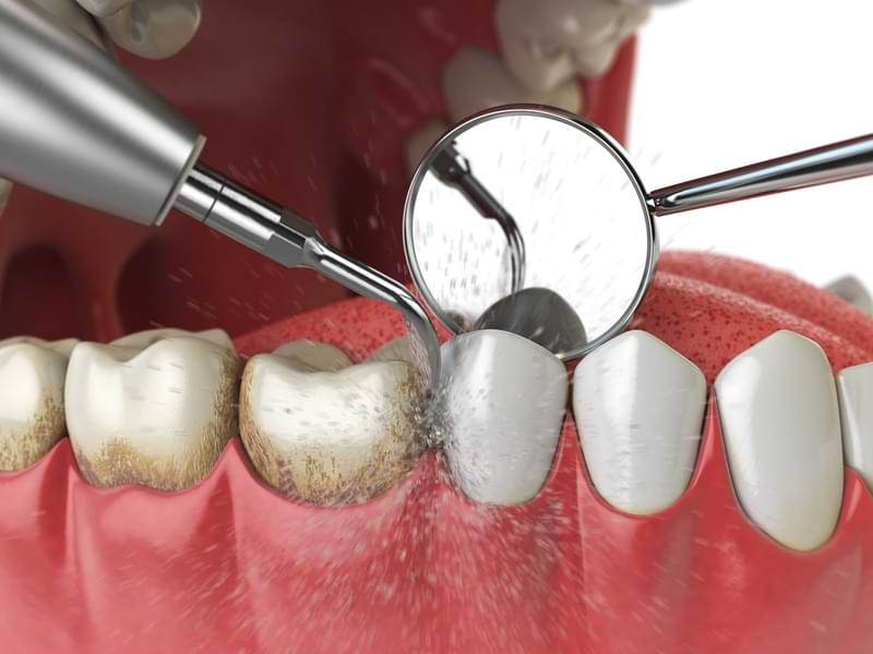 What to Expect During a Teeth Cleaning Appointment