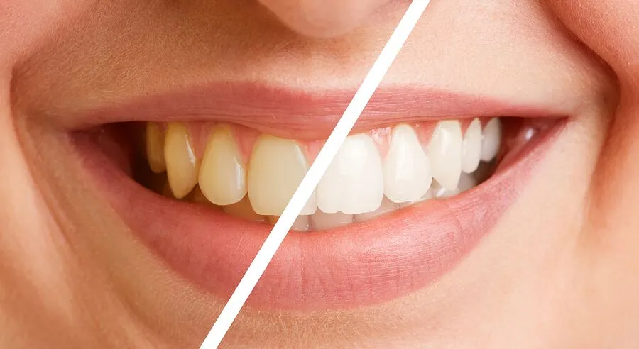 The Benefits of Teeth Polishing