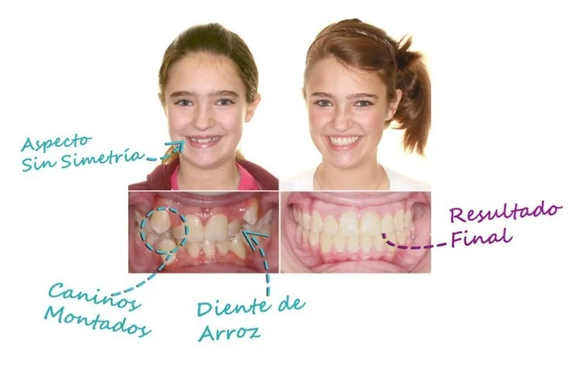 Los Brackets o Frenillos Dentales son la Mejor Solución. Los Frenillos tienen la capacidad de mover tus dientes y acomodarlos para  lograr una simetría perfecta.  El bueno de usar frenillos dentales es el corregir enormemente el aspecto de tu sonrisa.