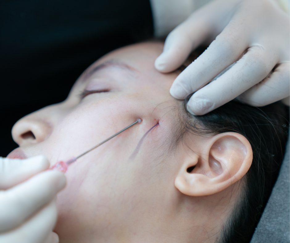 Morpheus8 combined with thread lift