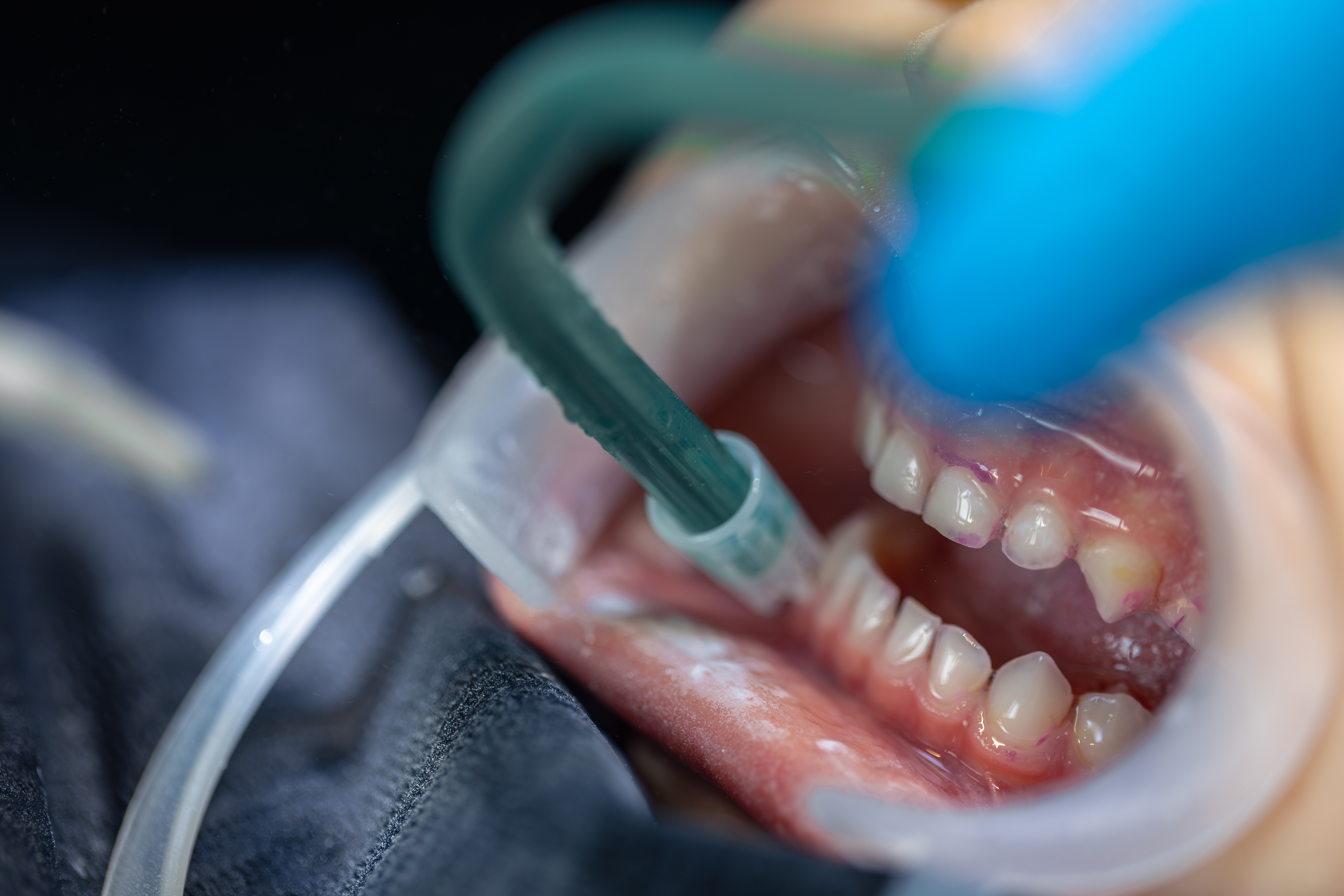 Chiuretajul și Detartrajul