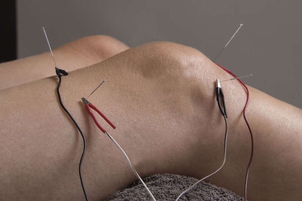 electro dry needling