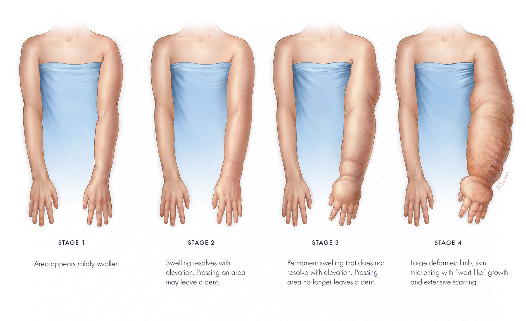 Medical illustration showing the stages of lymphedema in the upper limb—from early swelling to advanced tissue changes—used by MCB DME to educate patients on compression therapy options in New Jersey Medical illustration showing the stages of lymphedema in the upper limb—from early swelling to advanced tissue changes—used by MCB DME to educate patients on compression therapy options in New Jersey