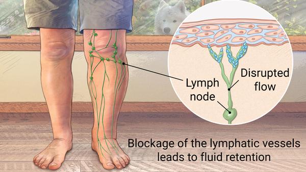 What is lymphedema What is lymphedema