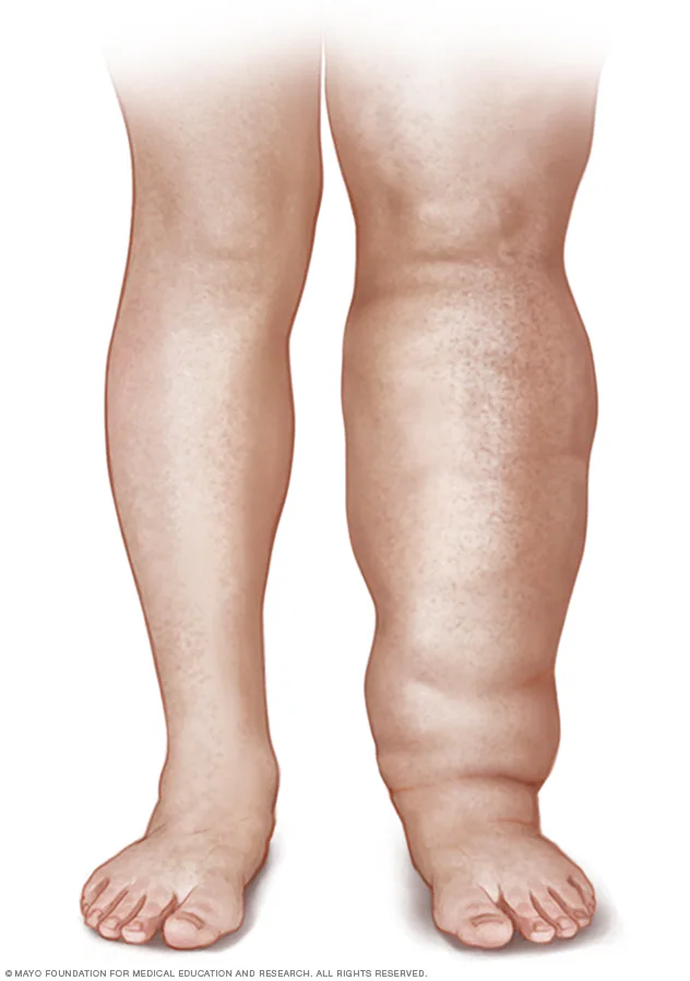 Lymphedema (leg) Lymphedema (leg)