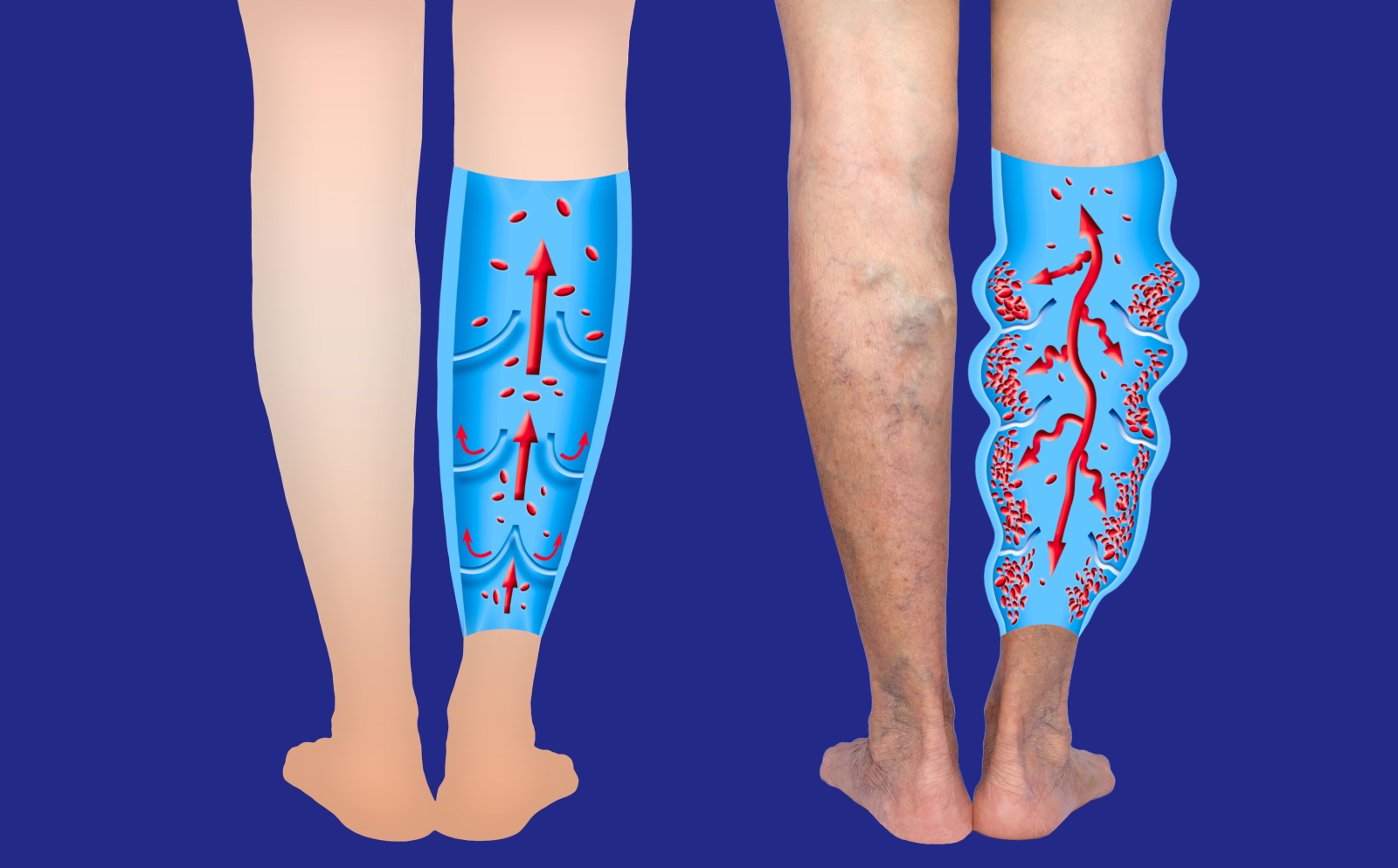 Side-by-side comparison showing symptoms of lymphedema and chronic venous insufficiency in legs
