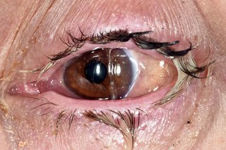 Conjunctivitis