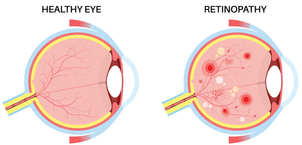 Retinopathy