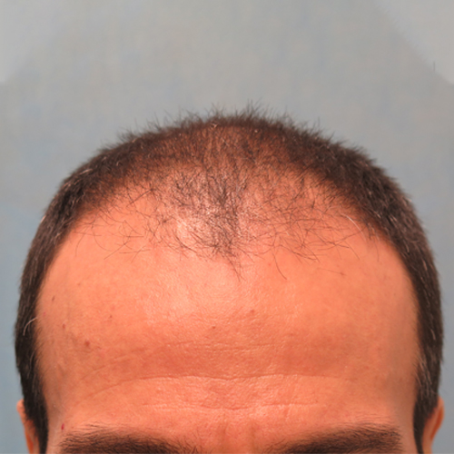 Before Treatment
