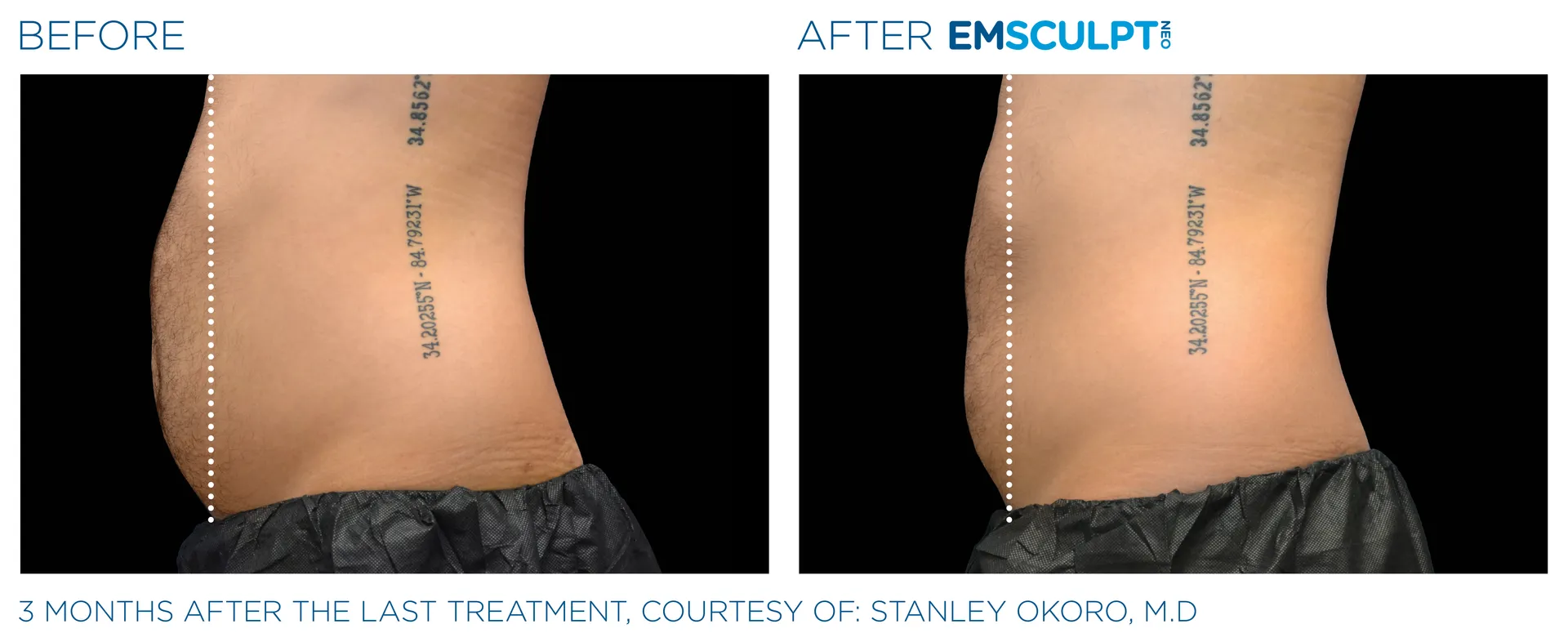 EmSculpt NEO • NEOSkin Medical Spa • Northeast OH, 234.205.2029