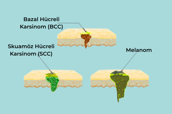 Bazal hücreli karsinom, Skuamöz Hücreli Karsinom ve malonom örneği Bazal hücreli karsinom, Skuamöz Hücreli Karsinom ve malonom örneği