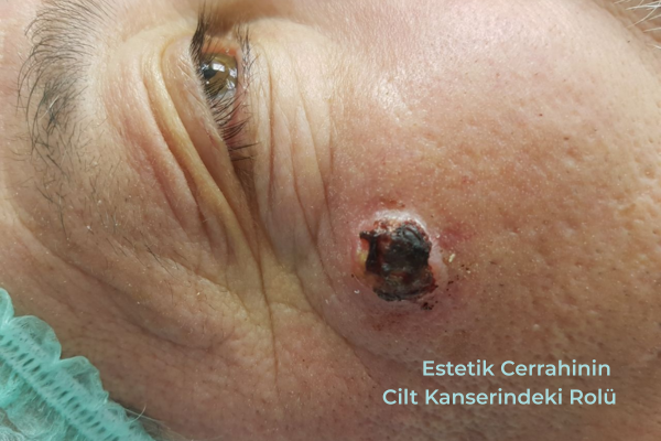 Estetik Cerrahinin Cilt Kanserindeki Rolü Estetik Cerrahinin Cilt Kanserindeki Rolü