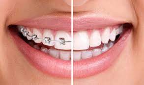 Braces vs Invisalign a literal depiction of a smile with half braces and half invisalign Braces vs Invisalign a literal depiction of a smile with half braces and half invisalign