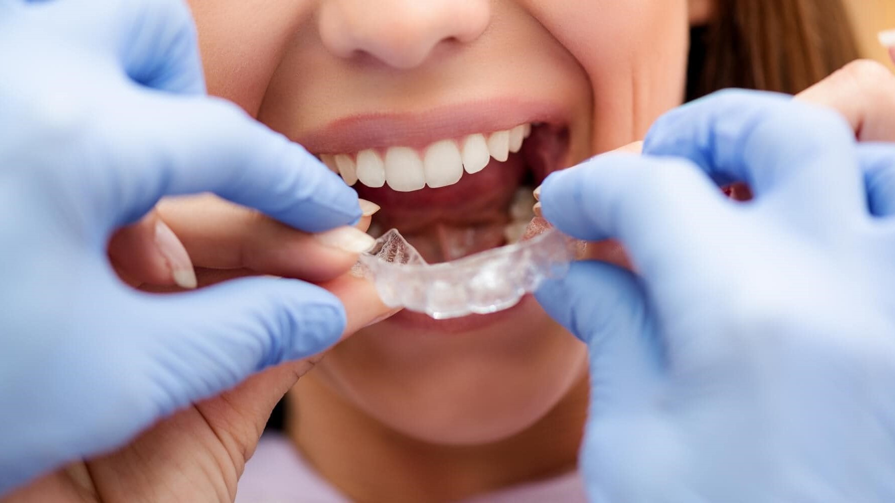 A patient putting in their retainer. A patient putting in their retainer.