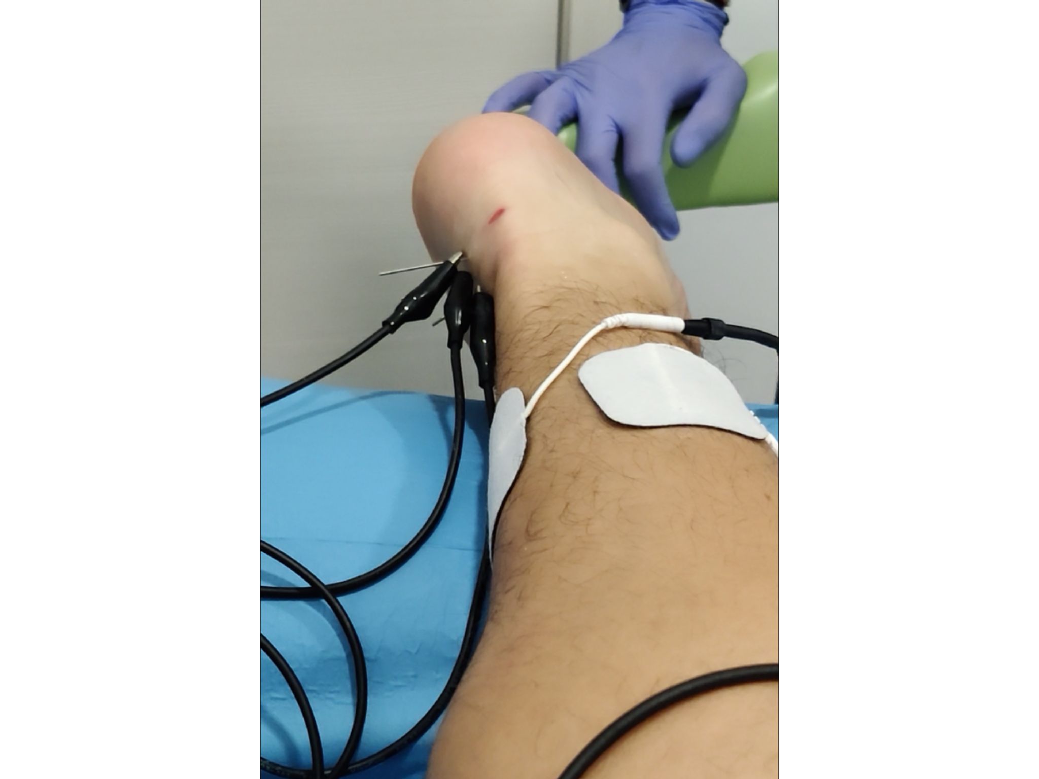 Electrical stimulation treatment