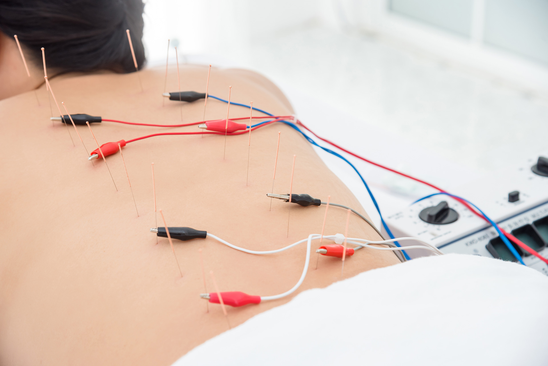 Standardized 8-point protocol of electrical dry needling for PF.