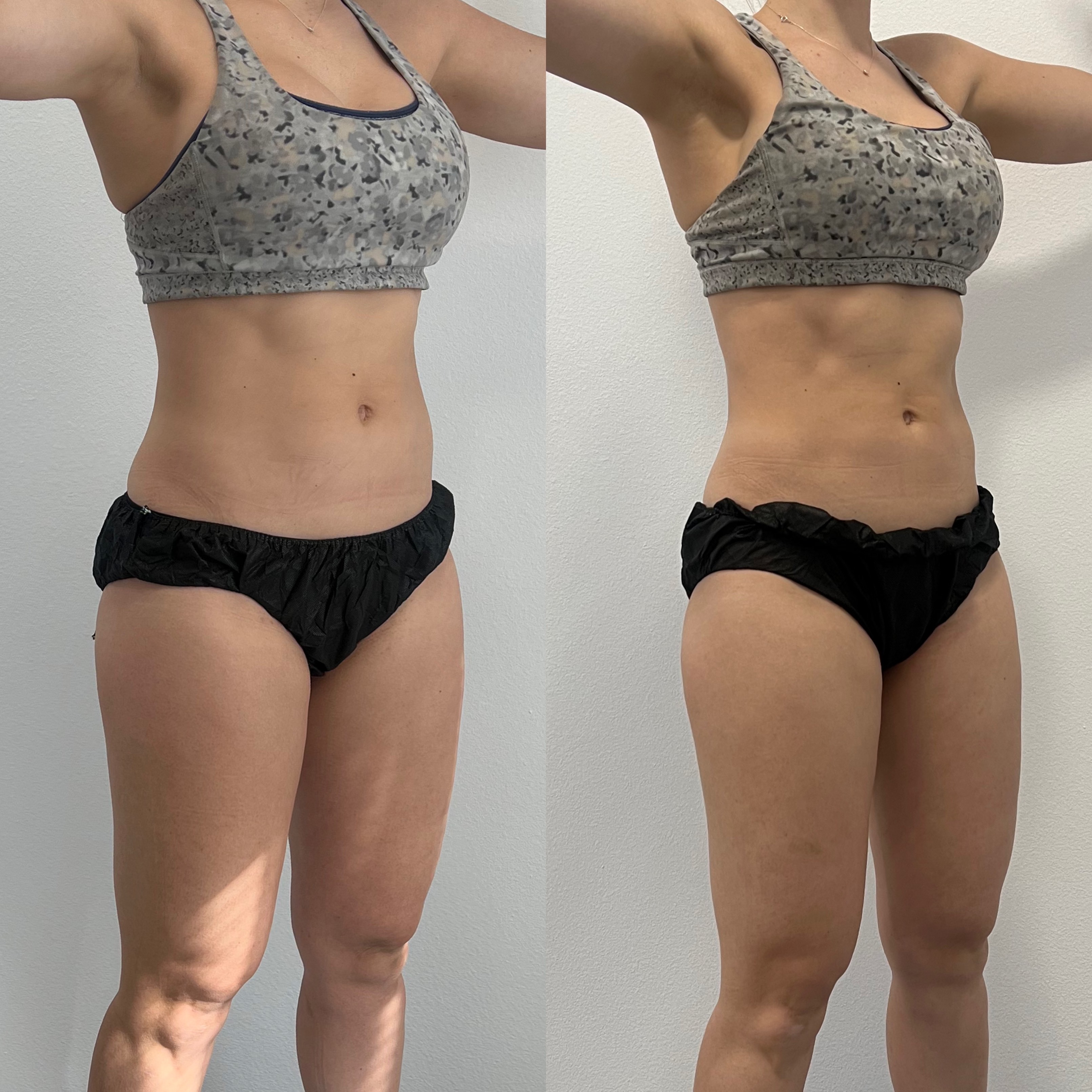can semaglutide raise your blood pressure How Semaglutide Works in Weight Loss and Type 2 Diabetes