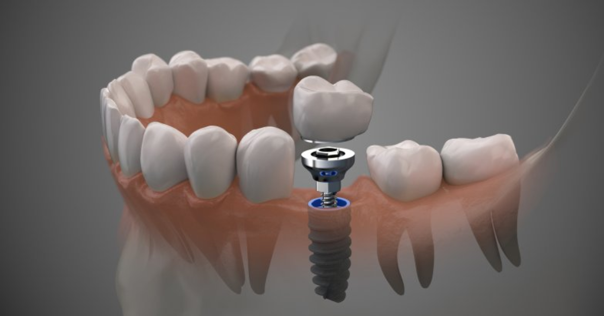 What does getting an implant feel like?