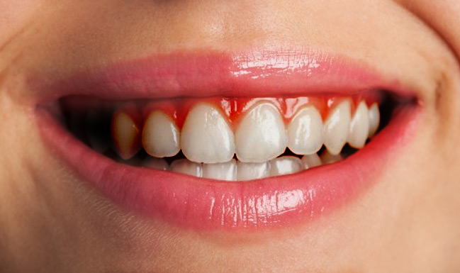 Treatment options for gums that keep bleeding when brushing teeth