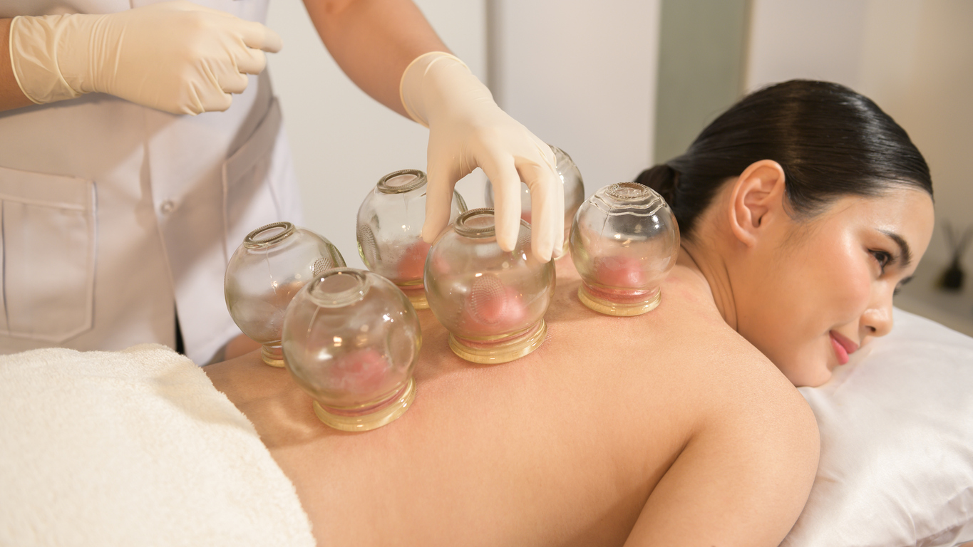 Cupping therapy in Spring TX