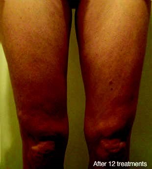 After Treatment