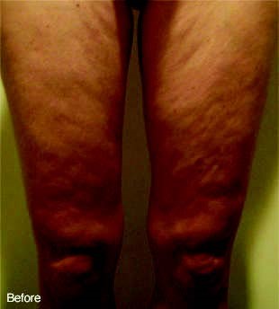 Before Treatment