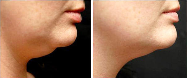Chin Results