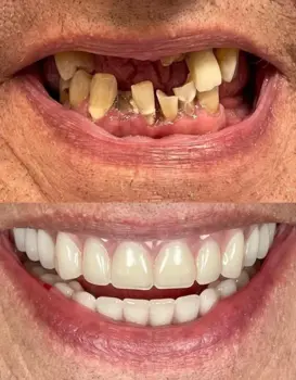 Smile Makeover All on Four