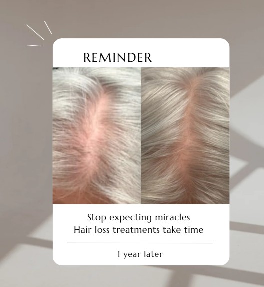 hair loss results; hair loss before and after; monat hair; hair loss solutions; natural haircare