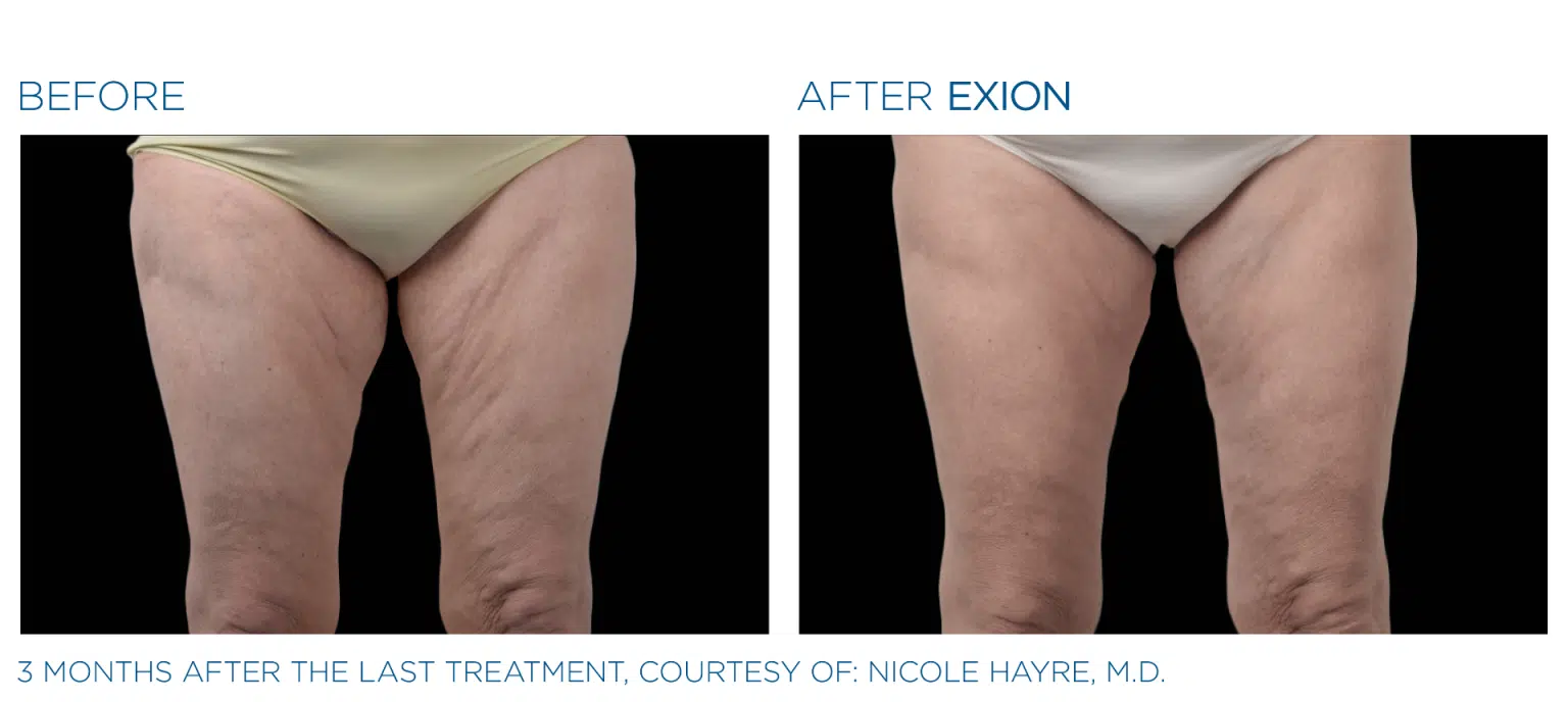 Before After Exion